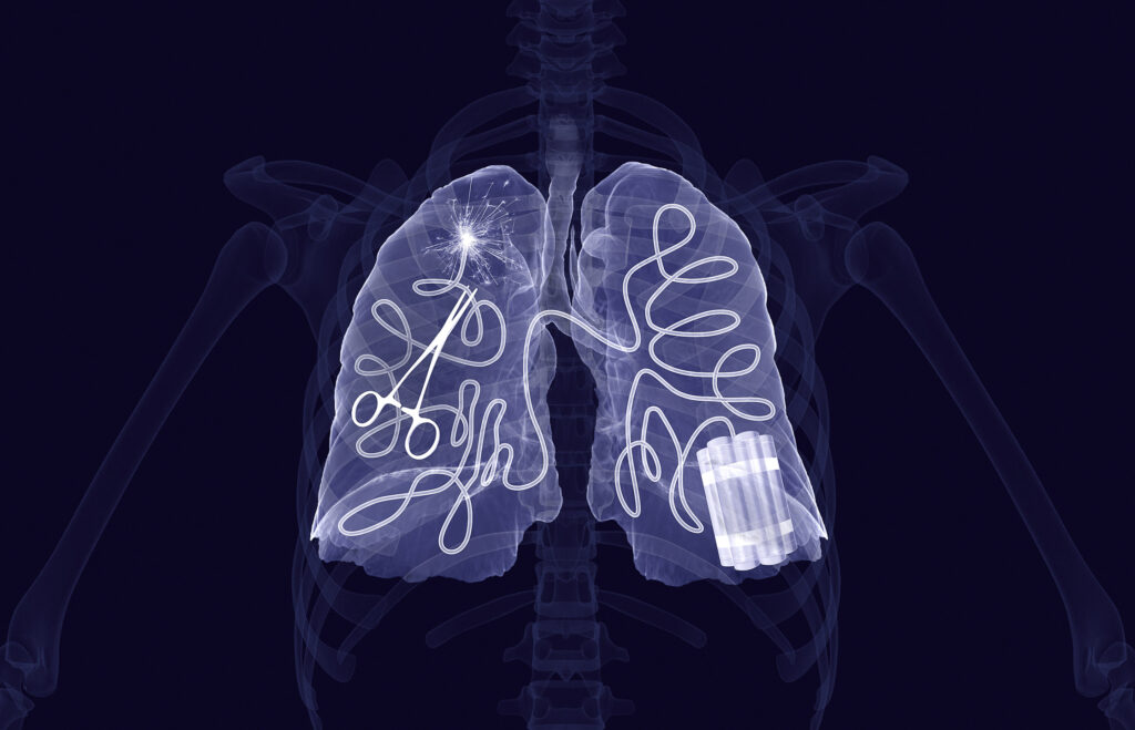 3d Rendering of lungs with illustrated explosives